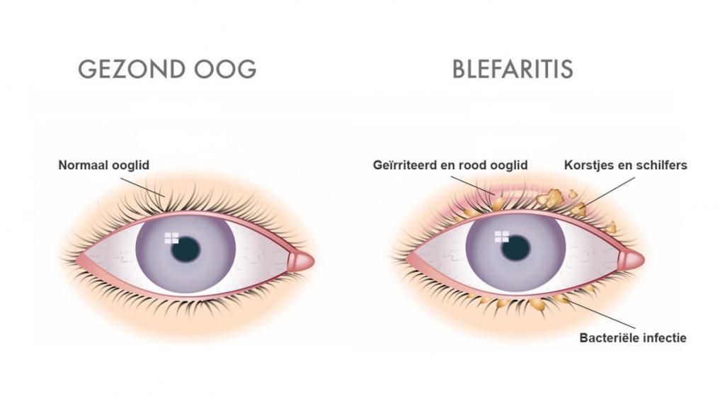 Wat is blefaritis?