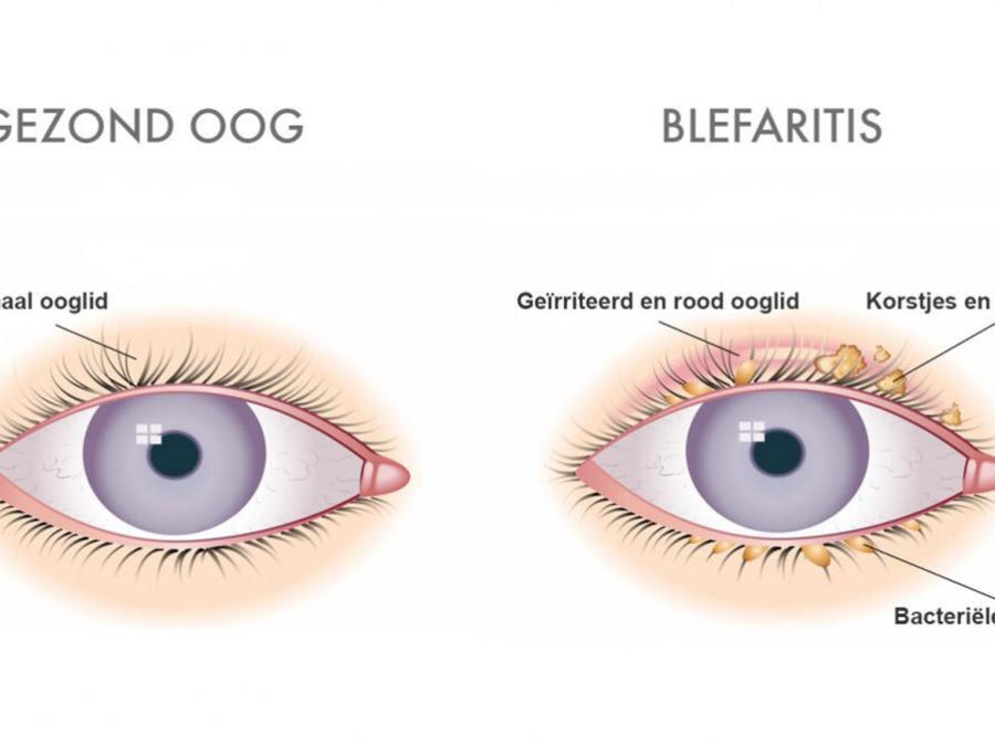 Wat is blefaritis?