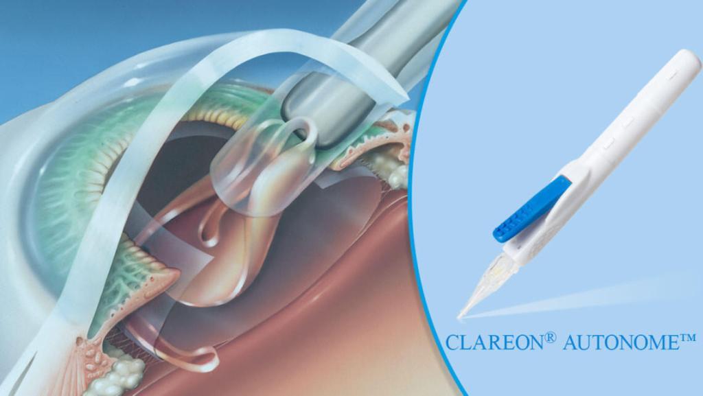 Nieuwste implantlens: Clareon® AutonoMe™