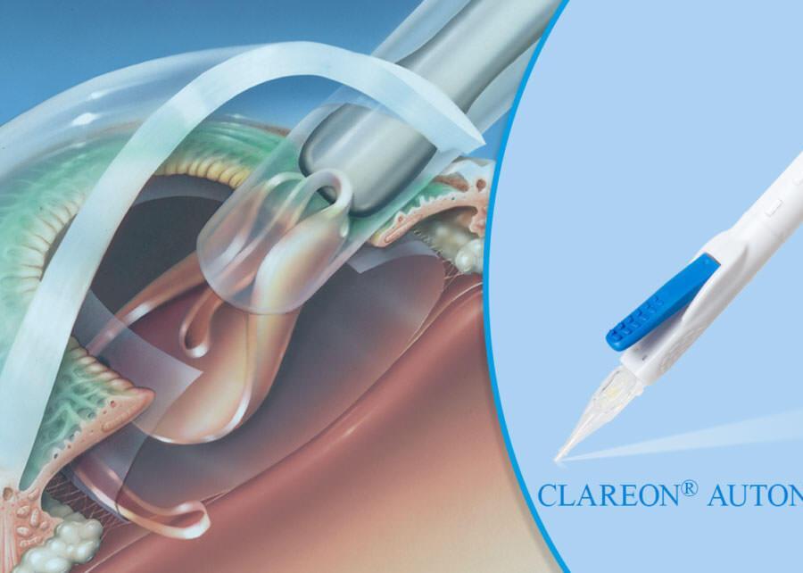 Nieuwste implantlens: Clareon® AutonoMe™